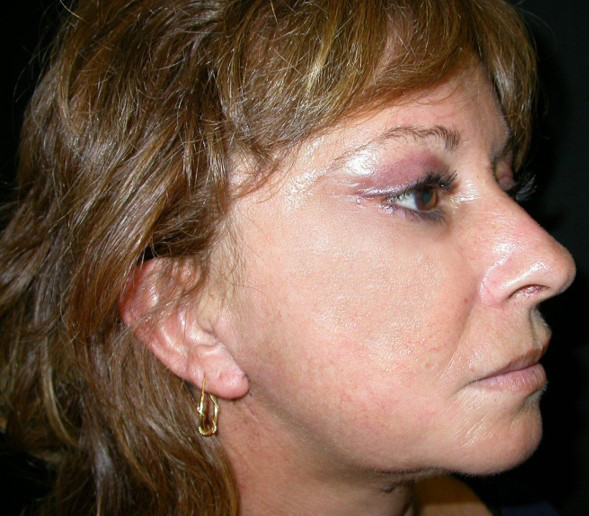 lifting-post lt dx